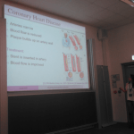 A large projector outlines details about coronary heart disease as Aoife stands off to the side presenting.